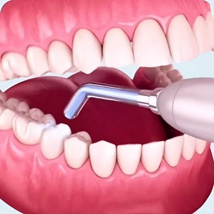 Cosmetic Fillings done by dr. ahmed el baradei at smile makers